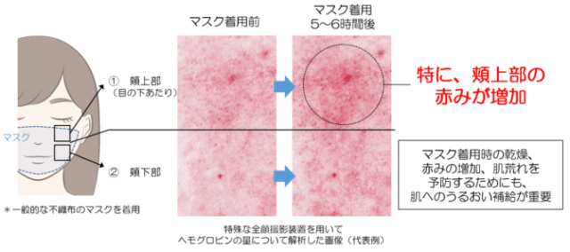 マスク生活によるマスク荒れやマスクネ 原因と今すぐできる対策を紹介 公式 ジェンダーレスコスメnalc ナルク 公式サイト